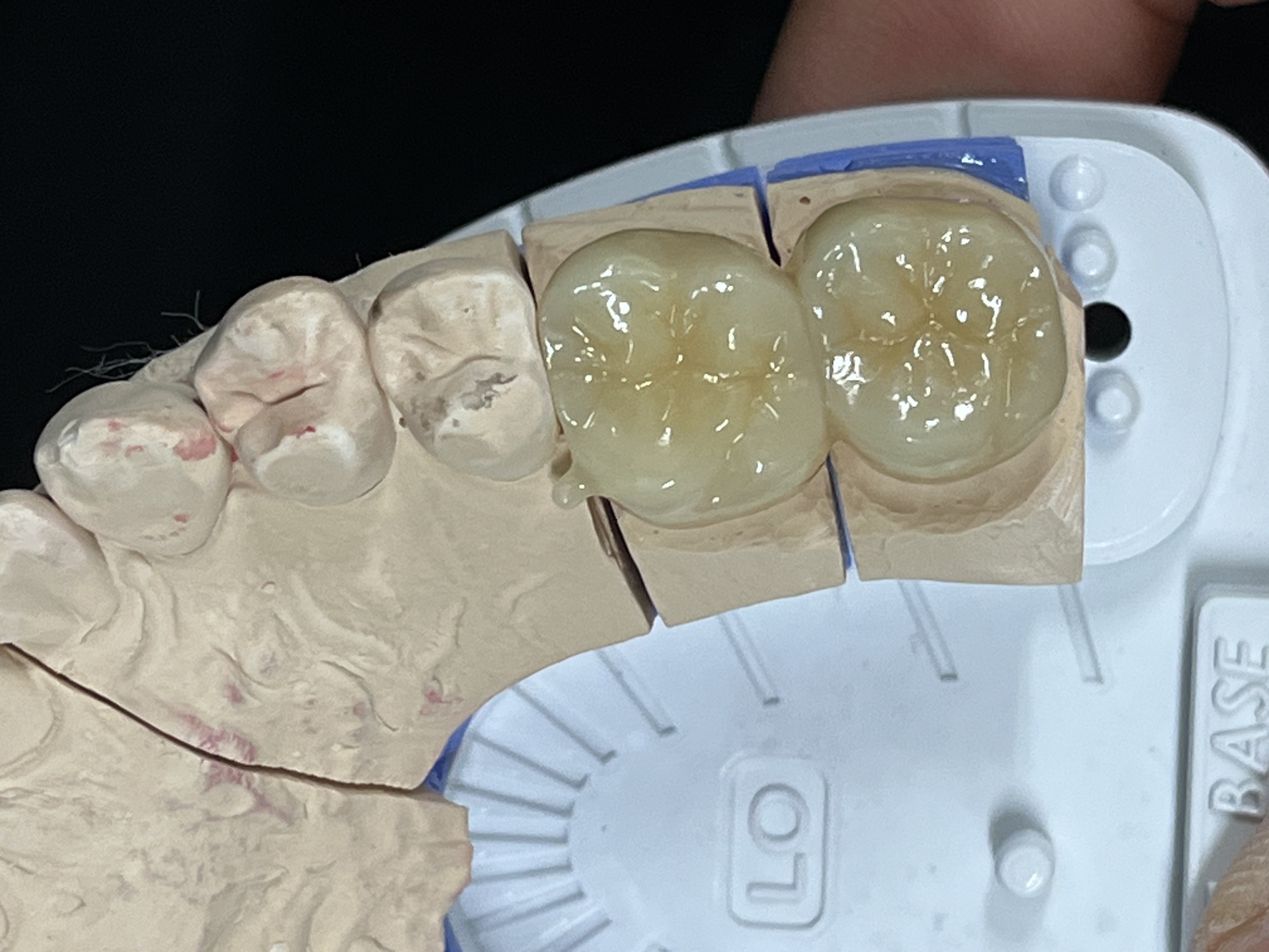 지르코니아 인레이